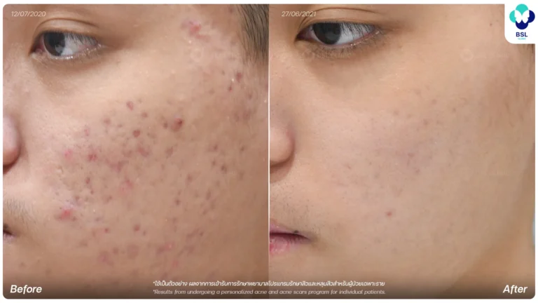 รีวิวรักษาหลุมสิวที่ BSL Clinic