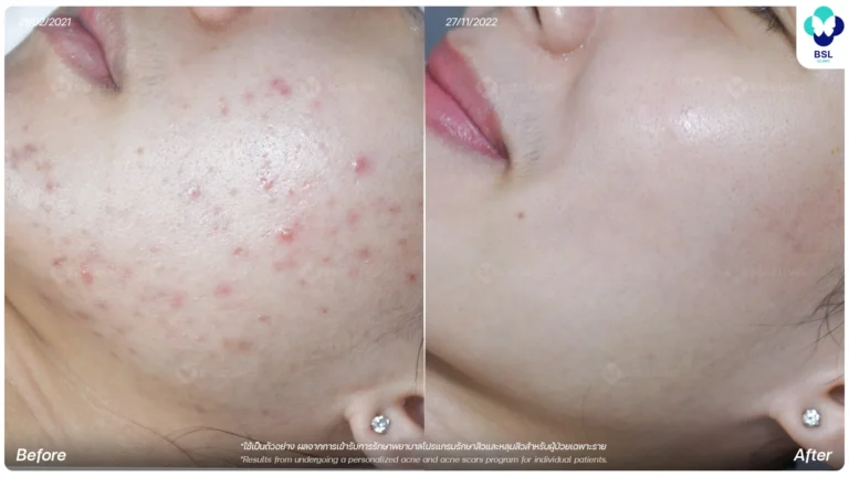 รีวิวรักษาหลุมสิว Ice Pick Scar ที่ BSL Clinic