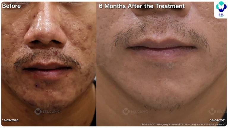 รีวิวรักษาหลุมสิว Box Scar ที่ BSL Clinic
