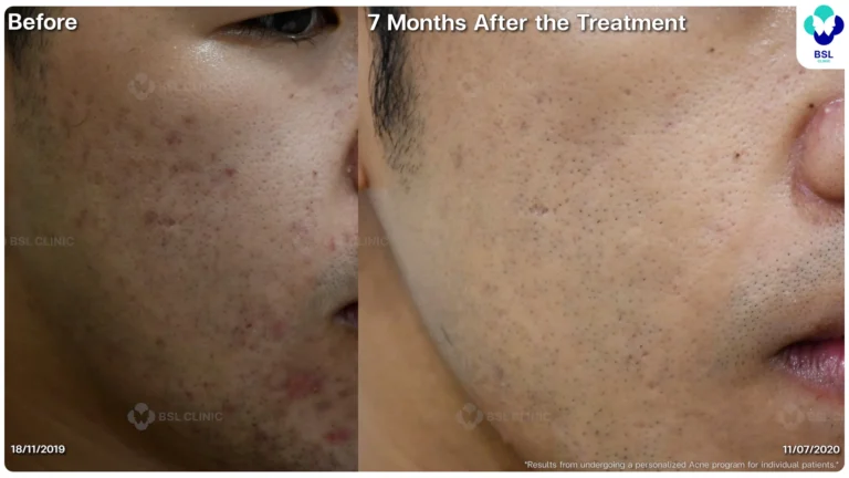รีวิวรักษาหลุมสิวที่ BSL Clinic