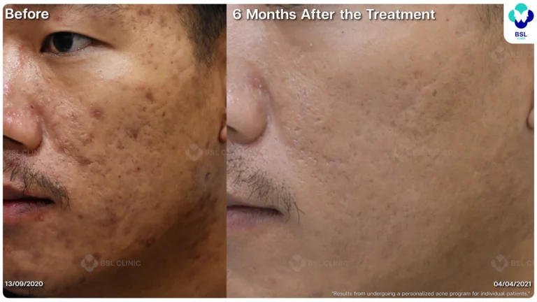 รีวิวรักษาหลุมสิว Ice Pick Scar ที่ BSL Clinic