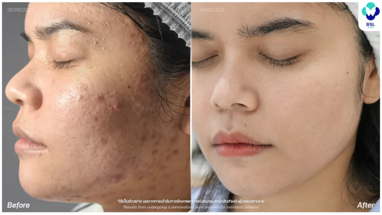 รีวิวรักษาหลุมสิวที่ BSL Clinic
